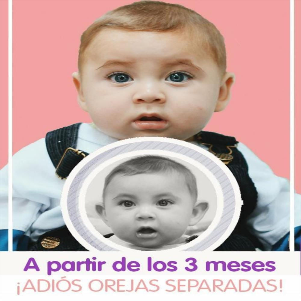 Otostick® Bebé 2 unidades - Otostick Colombia: corrector estético de orejas
