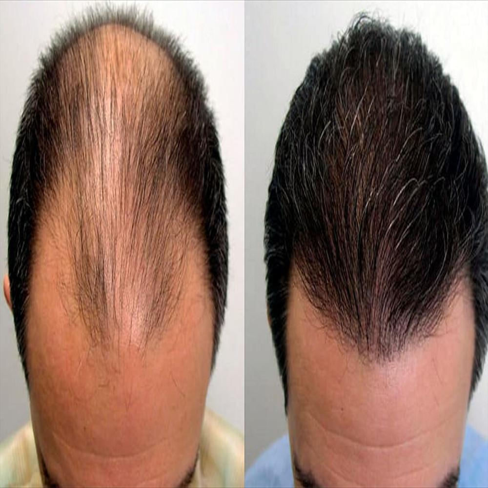 Tonico Para El Crecimiento Del Cabello 120 Ml 2 Unidades img #5